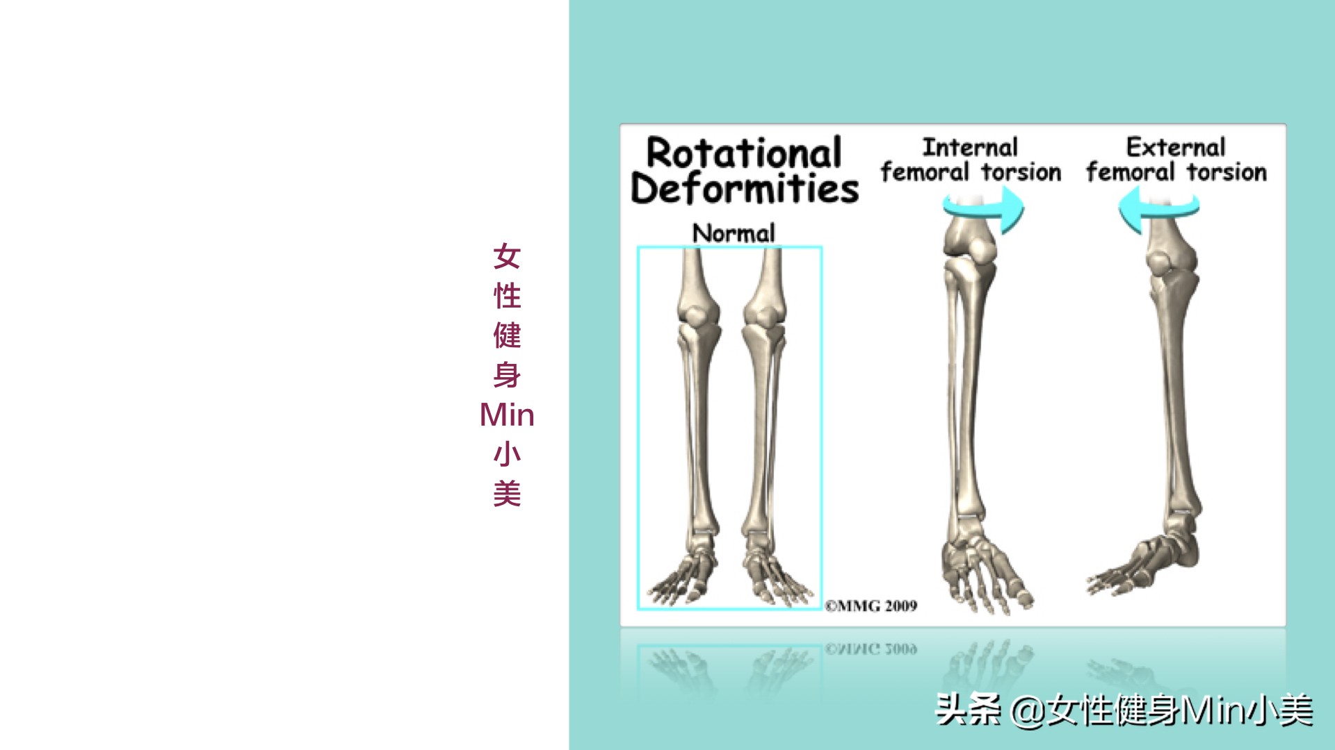 假胯宽、大腿外侧太粗都和它有关，一套动作帮你改善，重点是坚持