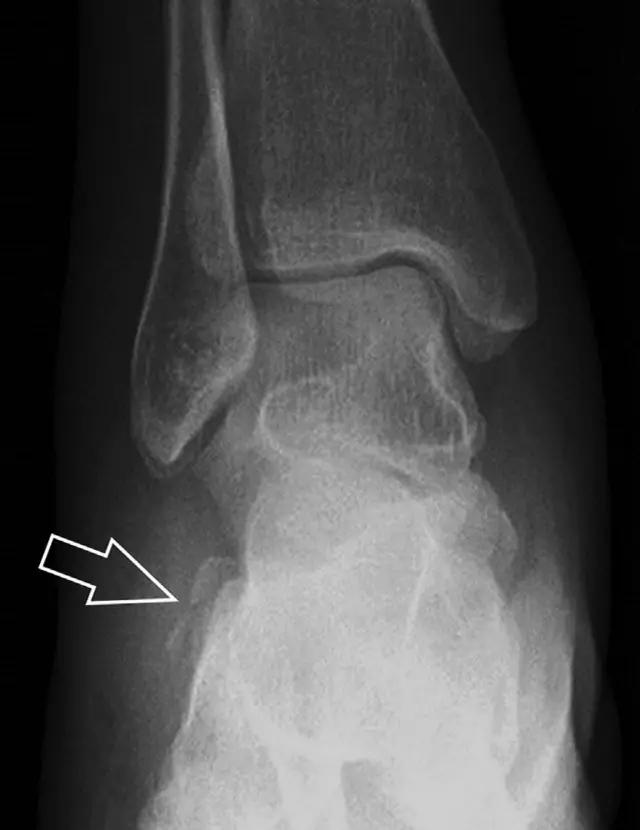 放射科夜班病例大全,放射科容易漏诊的骨折