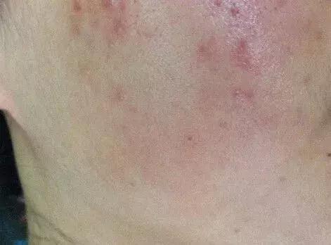 祛痘后脸上的痘印怎么去除,如何去除痘印4种方法就可以祛痘