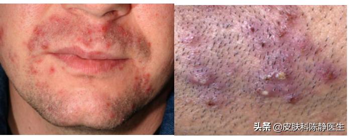 刮胡子毛囊炎凸起硬疙瘩怎么消除,刮胡子起小红点的毛囊炎怎么办