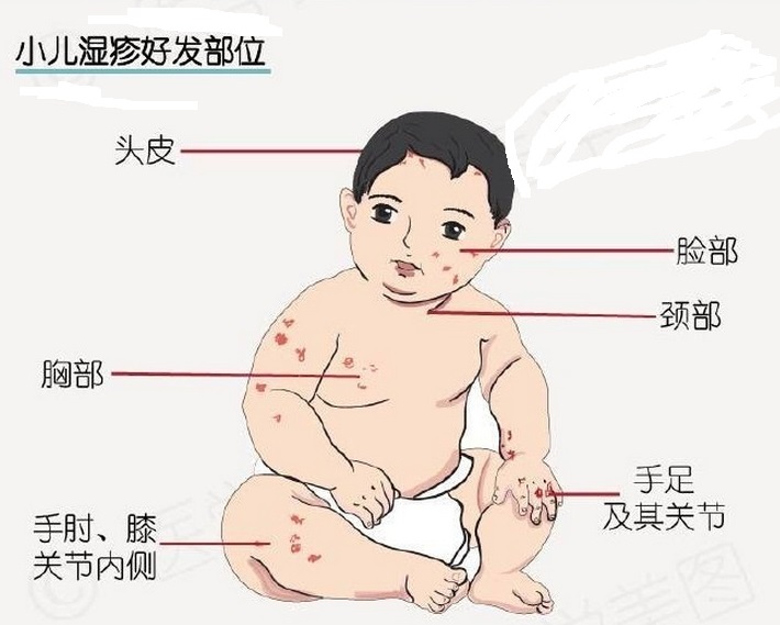 一文掌握5个治湿疹的中成药,湿疹最好的科普文章