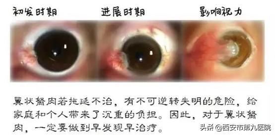 眼睛里长肉,眼睛翼状胬肉需要治疗吗