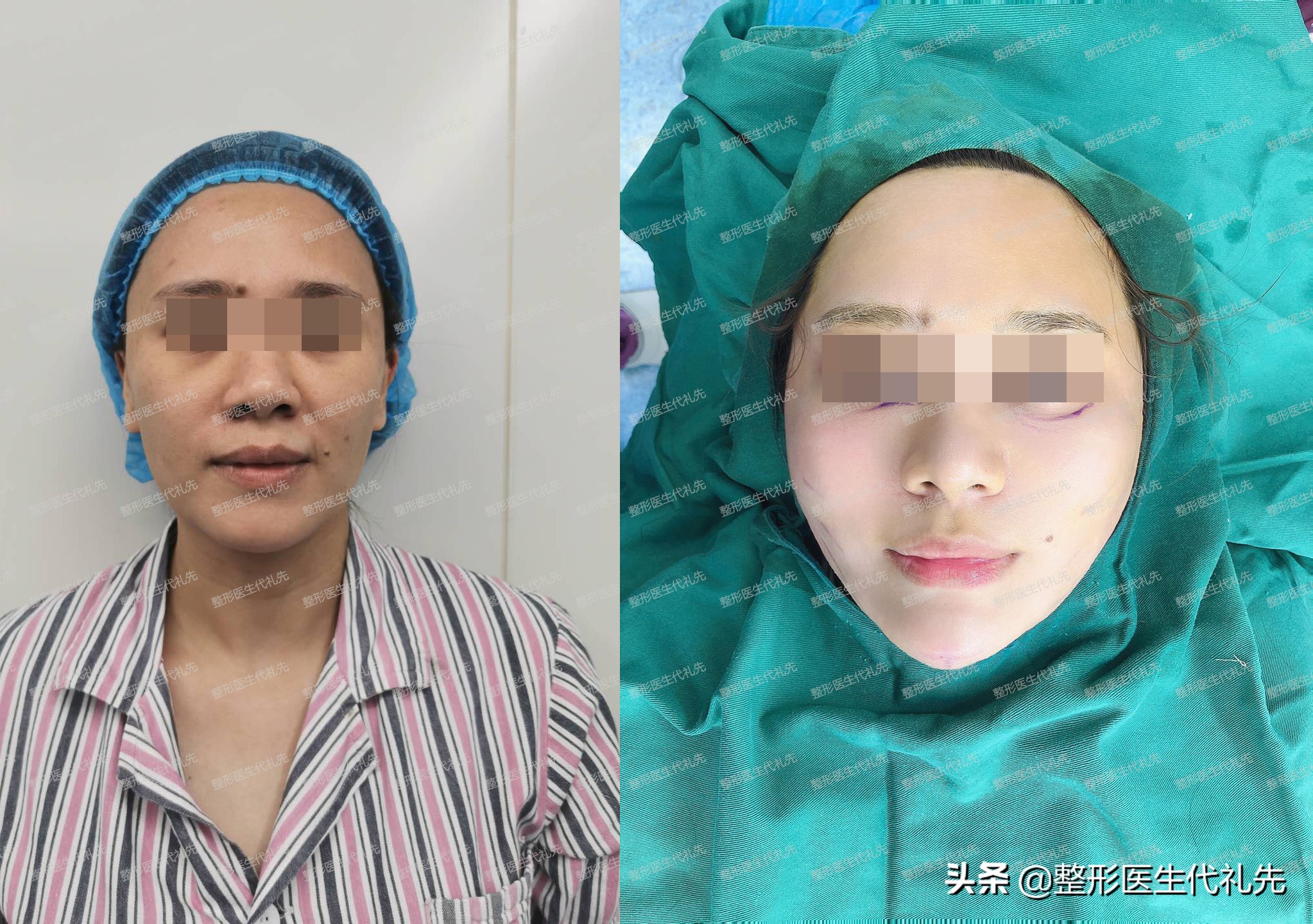 脸下垂松弛真能做面部提升有用吗,面部轮廓松弛下垂怎么改善