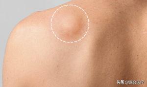 身上有个肿瘤要切除吗,怀疑其他部位有肿瘤需要怎么检查