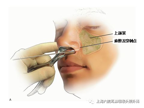 上颌窦炎穿刺手术全过程,上颌窦炎一般小门诊能治疗吗