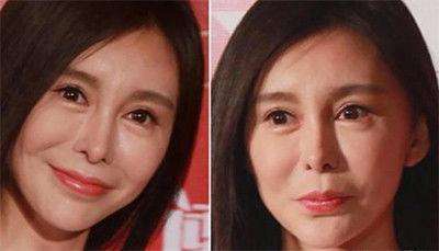 瘦脸针一年后出现后遗症如何补救,瘦脸针的后遗症失败案例图片