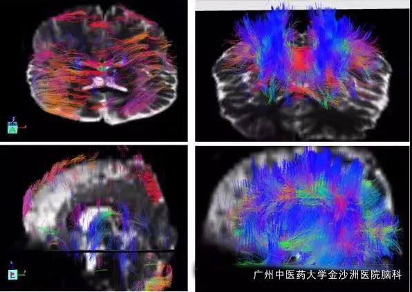 2019年脑瘫治疗新方法,10年内关于脑瘫治疗有没有进步