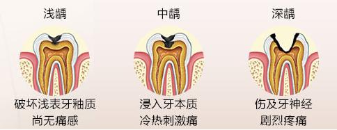 满口都是蛀牙很严重可以洗牙吗,蛀牙严重的牙齿都烂掉可以洗牙嘛
