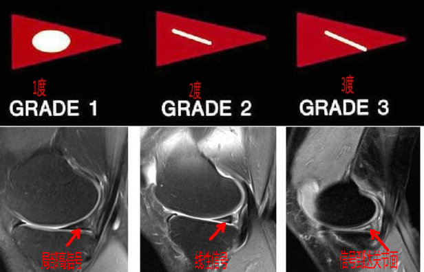 磁共振怎么看半月板损伤程度,磁共振半月板损伤1级是什么