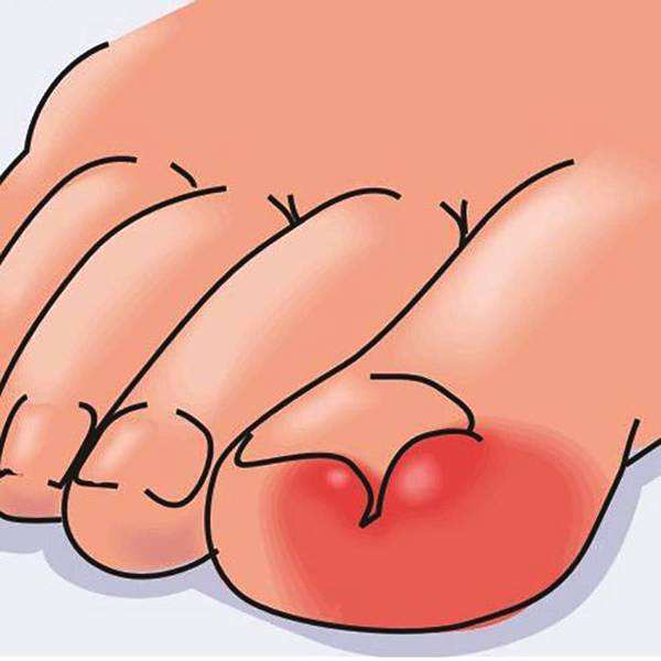 甲沟炎剪指甲好还是不剪好,很多人甲沟炎