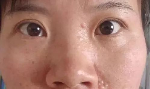 长了汗管瘤容易长皱纹,为什么会长汗管瘤和脂肪粒