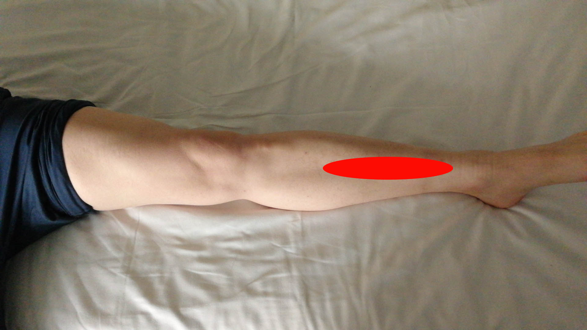 跑完步小腿疼？运动完迎面骨前侧疼？很多时候是它的原因！