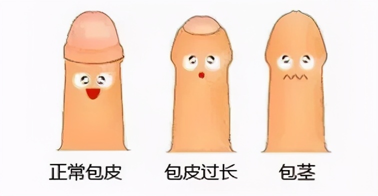 割包皮适合暑假还是寒假,割包皮手术寒假暑假可以做吗