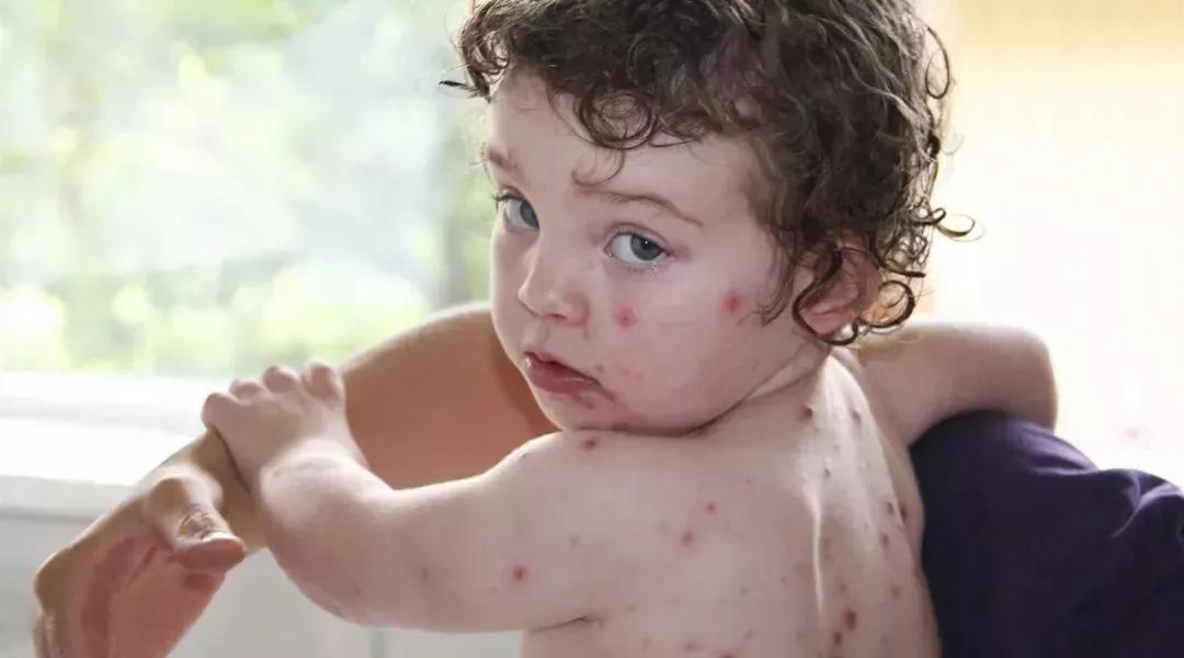 水痘防控知识,健康提示水痘高发准备战痘