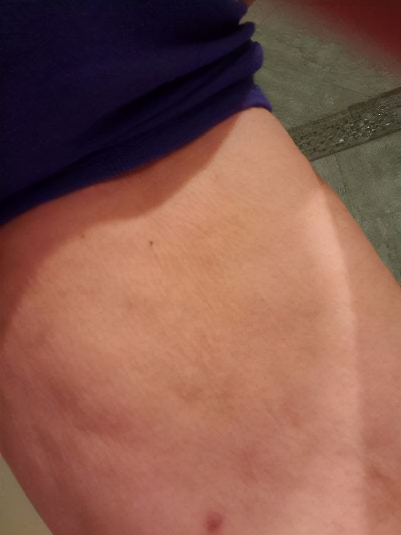 抽脂减肥成了植物人,整形抽脂死亡