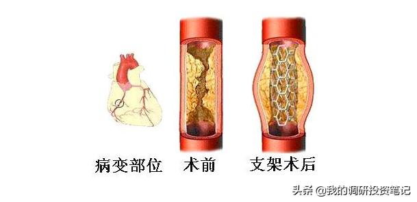 上市公司游记系列：欲往高处走的蓝帆医疗
