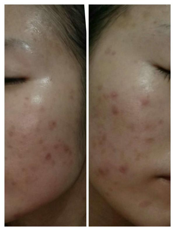 300多元祛痘,祛痘花了三万块