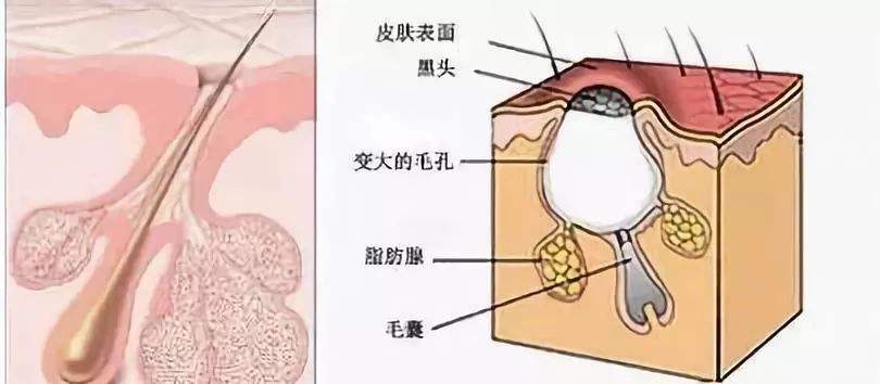 十七岁少女去黑头,怎么无成本去黑头学生