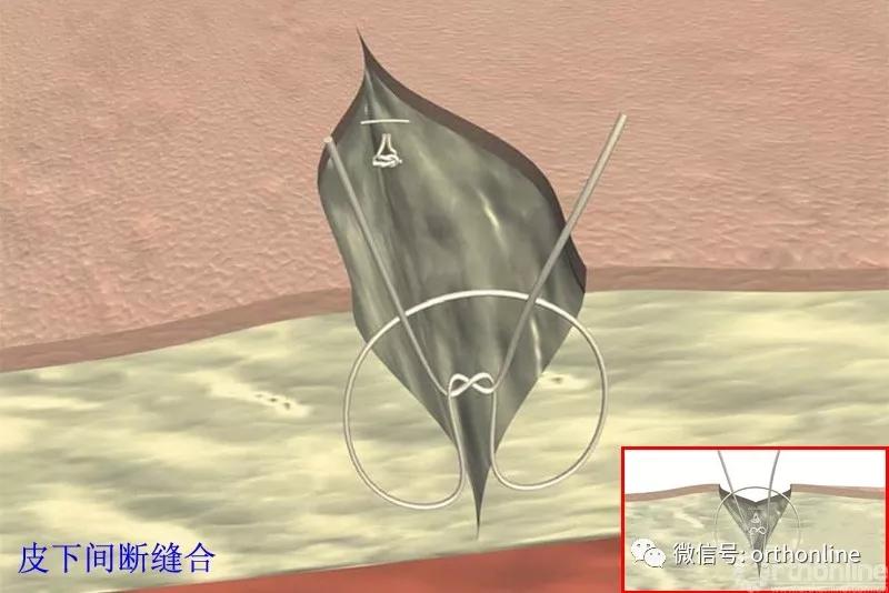 常用的手术缝合方法图,临床常见常用伤口缝合方法