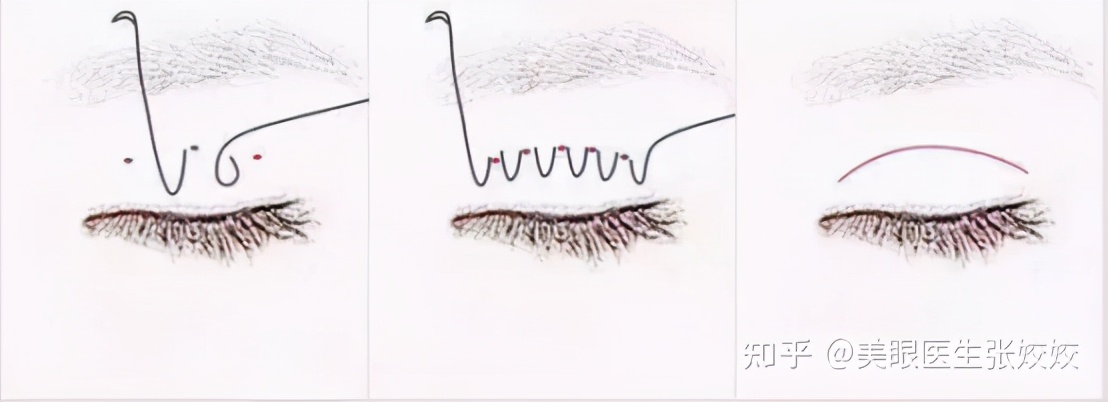 割双眼皮会影响运势吗,40岁割双眼皮效果图