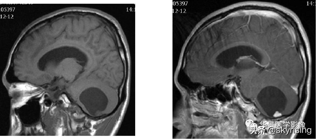 椎体侵袭性血管瘤mri影像学表现,中年妇女脑部血管海绵体瘤的症状