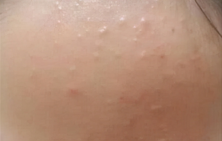 皮肤不光滑很多小颗粒怎么办,皮肤起密密麻麻小颗粒不痛不痒