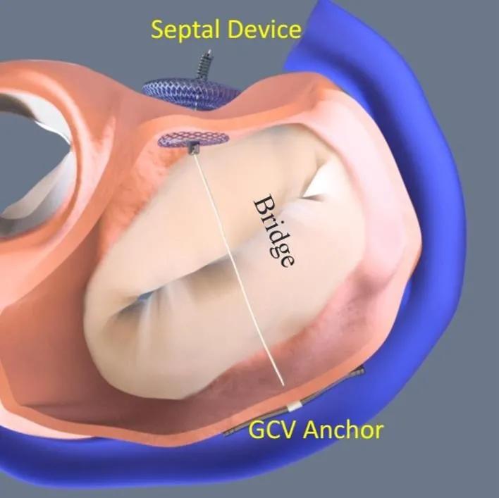 心脏“小门”关不严,经导管二尖瓣介入治疗,不开胸就换瓣