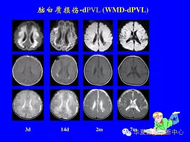 新生儿颅脑mri,新生儿颅脑mr报告模板