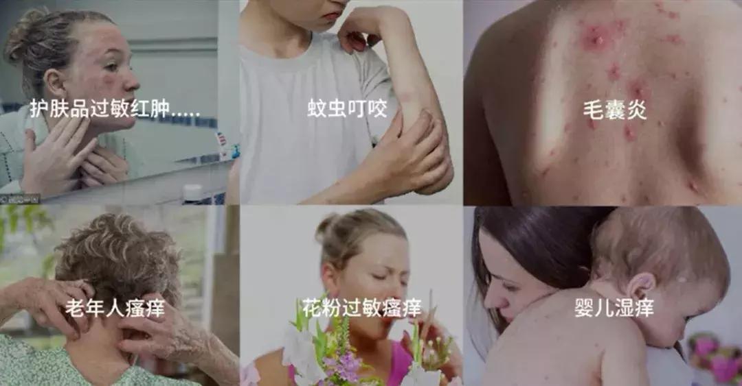 海得宝治疗什么,海得宝有没有激素