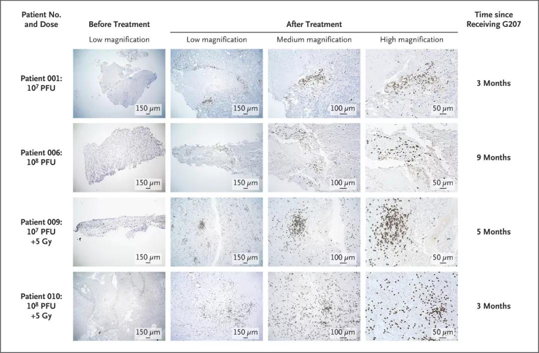 溶瘤腺病毒治疗恶性胶质瘤的研究,溶瘤病毒治疗脑胶质瘤
