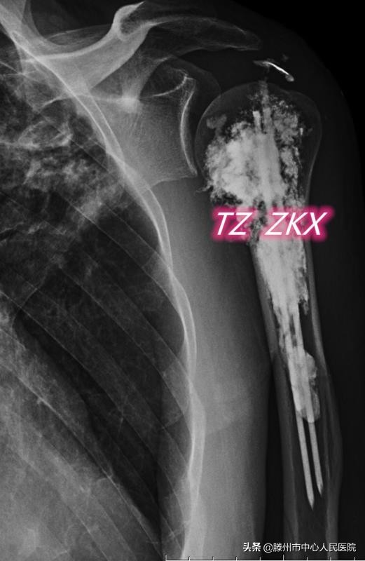 ct引导下椎间盘微创消融术辐射大,CT引导下腰椎射频消融术辐射大吗