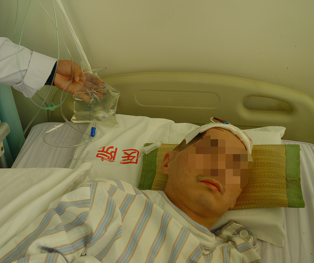 脑受伤开颅手术昏迷,开颅手术后20天发生脑积水引流