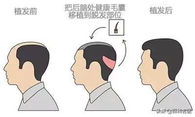 脱发严重怎样挽回发际线,发际线警告拯救脱发