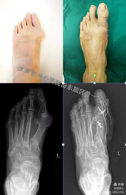 太原中心医院汾东院区骨科,太原汾东中心医院骨科拇外翻大夫