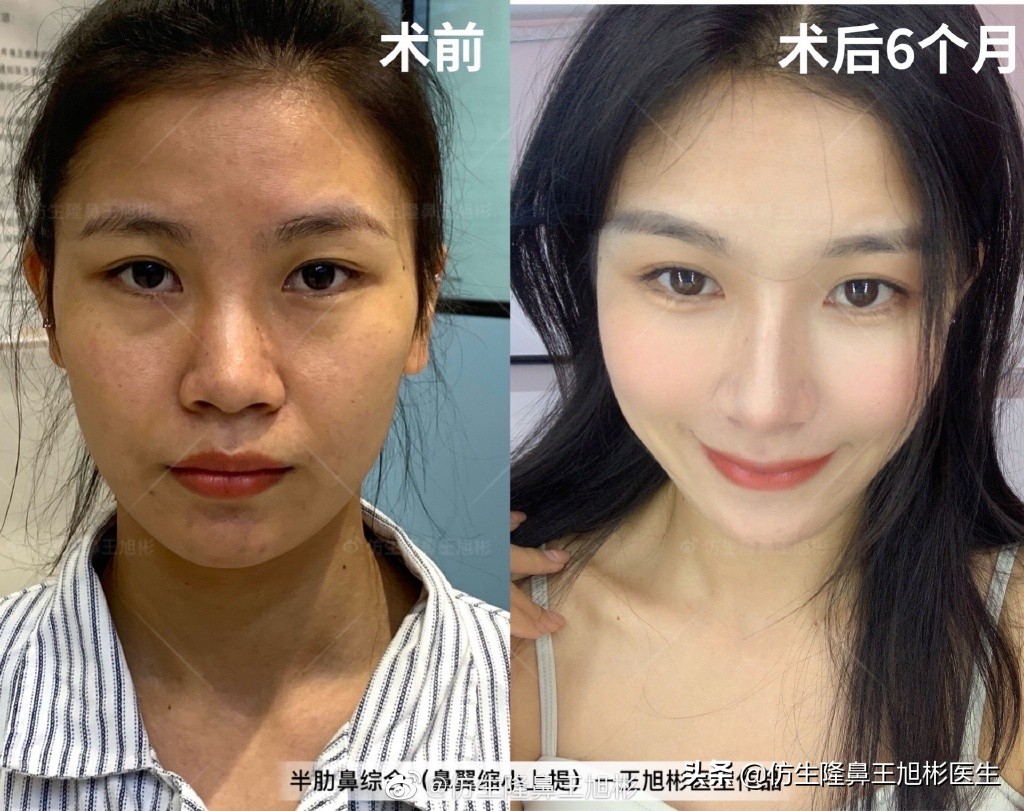 那些被鼻子“封印”颜值的鼻综合/修复案例|广州鼻整形