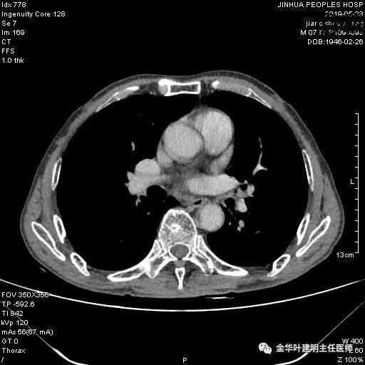 手术引起乳糜胸,有没有做了肺结节手术后是误诊的