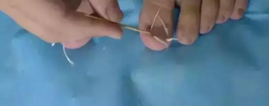 治疗甲沟炎真正有效的办法,甲沟炎指甲剪神器正品