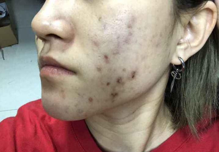 最新口罩戴法防闷痘,口罩闷出的痘印怎么消