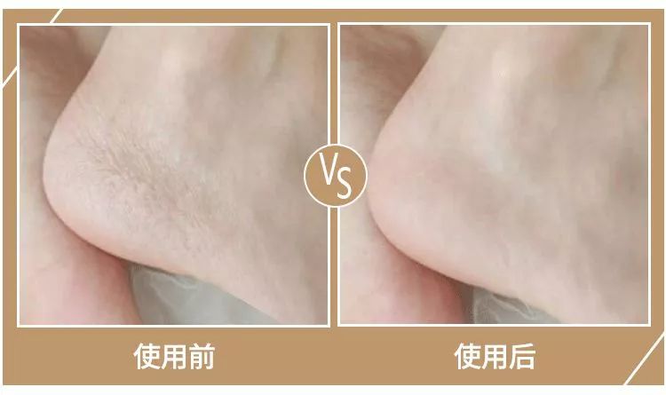 秋冬手干裂擦手霜,冬天手脚干裂涂什么护肤品