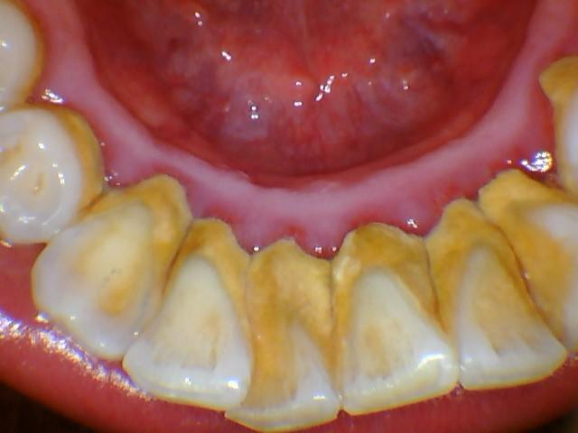 牙缝很臭正常吗,牙缝里很臭是牙的原因吗