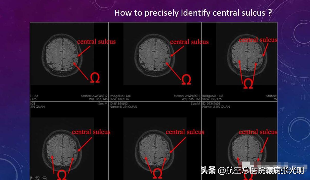 张光明左颞叶癫痫手术成功率,张光明谈治疗癫痫的方法有哪些