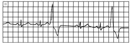 心悸是一种什么样的体验？心跳加快，就是心悸吗？