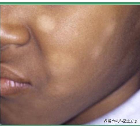 孩子脸上虫斑什么样,孩子脸上的虫斑到底是什么