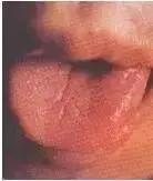 老中医舌苔从厚变薄了,任博士老中医讲舌苔