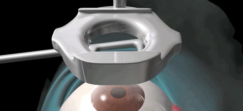 激光治疗近视什么原理,激光矫正是什么原理