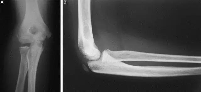 几种严重骨折医学名称,常见的骨折有哪些名称