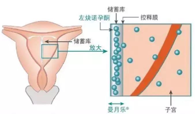 曼月乐避孕环多久有避孕效果,曼月乐避孕环是怎么避孕