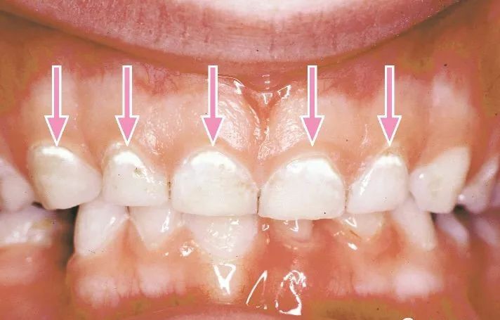 牙齿黑的地方是不是虫牙,黄牙黑牙有什么方法解决