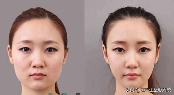 瘦脸针敢不敢打,瘦脸针不要随便打