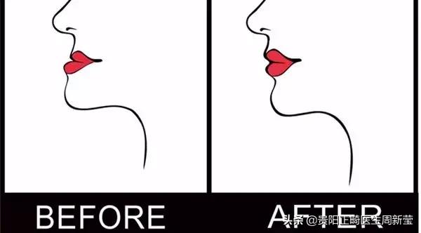 什么是“地包天”，地包天又该如何预防呢？